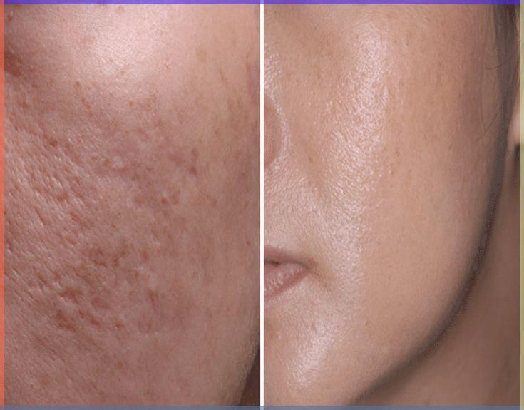 The Best Over-the-Counter Ingredients to Fade Dark Spots and Mild Acne Scars